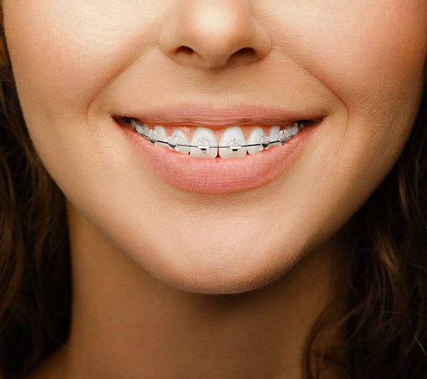 Clear Braces For Teens - All Star Orthodontics Camas, WA