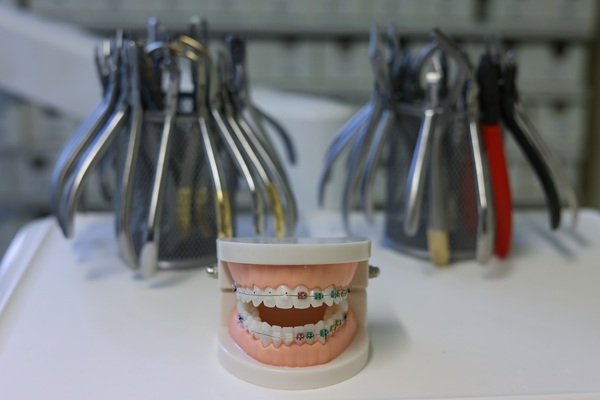 What To Know Before Getting Ceramic Braces
