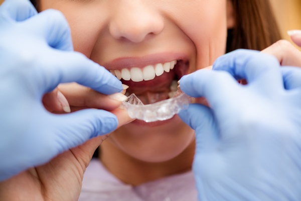 How Do Clear Aligners Work? [Orthodontist FAQ]