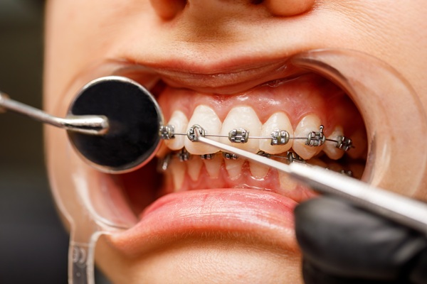 The Key Advantages Of Orthodontist Led Teeth Straightening